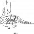 Ilustración 5 de Sistema de compresión y fijación de pie, tobillo y extremidad inferior