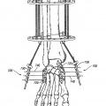 Ilustración 6 de Sistema de compresión y fijación de pie, tobillo y extremidad inferior