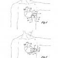 Ilustración 2 de Cardioversor-desfibrilador y marcapasos opcional implantables sólo subcutáneamente.