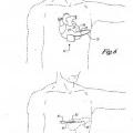 Ilustración 3 de Cardioversor-desfibrilador y marcapasos opcional implantables sólo subcutáneamente.