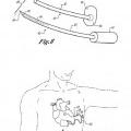 Ilustración 4 de Cardioversor-desfibrilador y marcapasos opcional implantables sólo subcutáneamente.