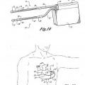 Ilustración 5 de Cardioversor-desfibrilador y marcapasos opcional implantables sólo subcutáneamente