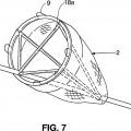 Ilustración 5 de Instrumentos de posicionamiento para implantar una bolsa de saciedad