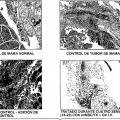 Ilustración 8 de Células madre mesenquimales CD34 negativas modificadas genéticamente para el tratamiento de tumores