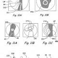Ilustración 9 de Sistema de realización de procedimientos dentro del oído, nariz, garganta y senos paranasales
