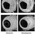 Ilustración 4 de Métodos cuantitativos para obtener características de un tejido a partir de imágenes de tomografía por coherencia óptica.
