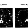 Ilustración 12 de Medios y procedimientos para el tratamiento de enfermedades tumorales