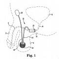 Ilustración 1 de Sistema de esfínter urinario artificial que tiene un manguito con un balón o globo fijado a un bastidor.