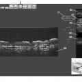 Ilustración 8 de Sistema y procedimiento para tomografía de coherencia óptica