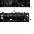Ilustración 1 de Ensayo para la metilación en el gen para la GST-Pi.