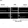 Ilustración 5 de Ensayo para la metilación en el gen para la GST-Pi.