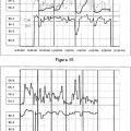 Ilustración 11 de Detección de estados hipocinéticos y/o hipercinéticos
