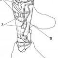 Ilustración 1 de Dispositivo de medición del perímetro de una extremidad durante la práctica deportiva