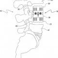 Ilustración 5 de Miembro de placa de soporte de un dispositivo de sustitución del cuerpo vertebral, y método de montaje asociado