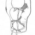 Ilustración 2 de Prenda celulósica carboximetilada como apósito para heridas