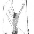 Ilustración 4 de Prenda celulósica carboximetilada como apósito para heridas.
