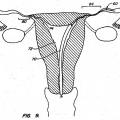 Ilustración 4 de Dispositivos contraconceptivos transcervicales de oclusión de las trompas de Falopio.