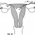 Ilustración 5 de Dispositivos contraconceptivos transcervicales de oclusión de las trompas de Falopio