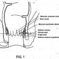 Ilustración 1 de Dispositivo para incontinencia fecal.