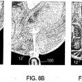 Ilustración 7 de Dispositivo para incontinencia fecal