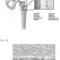 Ilustración 9 de Implantes que comprenden metales biodegradables y procedimiento para la fabricación de los mismos