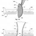 Ilustración 7 de Prótesis para hernia umbilical