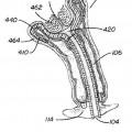 Ilustración 4 de Dispositivo de estabilización de cuello uterino.