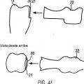 Ilustración 8 de Procedimiento y dispositivo para la producción de una prótesis dental