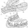 Ilustración 4 de Sistemas de retención dental.