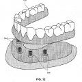 Ilustración 11 de Sistemas de retención dental