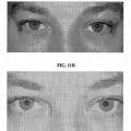 Ilustración 9 de Composiciones y métodos para el blanqueamiento del ojo