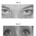 Ilustración 10 de Composiciones y métodos para el blanqueamiento del ojo