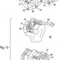 Ilustración 4 de Instrumental para la inserción de una prótesis articulada, en particular prótesis de rodilla