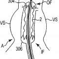 Ilustración 4 de Válvula protésica expansible dotada de apéndices de anclaje