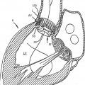 Ilustración 3 de Válvula cardíaca reposicionable