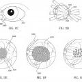 Ilustración 28 de Radiocirugía ocular
