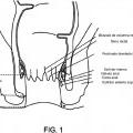 Ilustración 1 de Dispositivo y sistema para incontinencia fecal