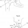 Ilustración 10 de Dispositivo de articulación de cadera