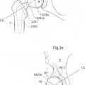 Ilustración 11 de Dispositivo de articulación de cadera