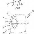 Ilustración 3 de Aparato para uso en artroplastia en una articulación de rodilla