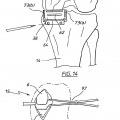 Ilustración 10 de Aparato para uso en artroplastia en una articulación de rodilla