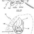 Ilustración 16 de Aparato para uso en artroplastia en una articulación de rodilla