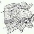 Ilustración 4 de Implante para el apoyo mutuo de las apófisis espinosas de cuerpos vertebrales.
