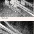 Ilustración 2 de Sistema de remodelación y / o ablación excéntrica seleccionable de material ateroesclerótico