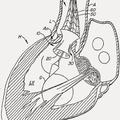 Ilustración 1 de Válvula cardiaca sustituible.