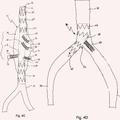 Ilustración 3 de Prótesis vascular intraluminal con fenestración in situ.