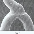 Ilustración 3 de Método para conformar un stent y un stent obtenido con dicho método