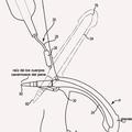 Ilustración 3 de Prótesis de pene inflable de manera peristáltica