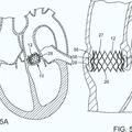 Ilustración 1 de Aparato de suministro de válvula cardiaca protésica que presenta un mecanismo de embrague.