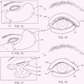 Ilustración 3 de Sistemas de tratamiento de ojo seco.